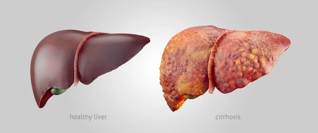 Cirrosis Hepática: Cuidado Integral para Mejorar la Calidad de Vida