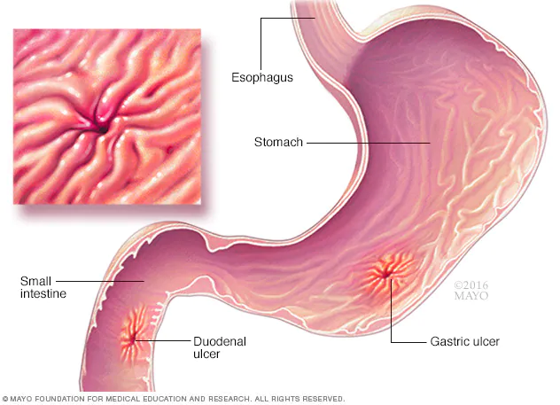 Manejo Integral de las Úlceras Gástricas e Intestinales: Tratamiento para Sanar y Prevenir Recurrencias